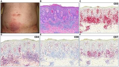 Utility of T-cell immunosequencing in distinguishing mycosis fungoides progression from treatment related cutaneous adverse events